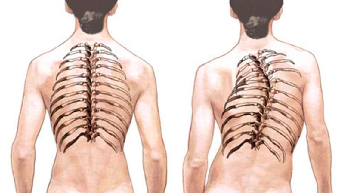 Scoliosis treatment to correct deviations of the spine